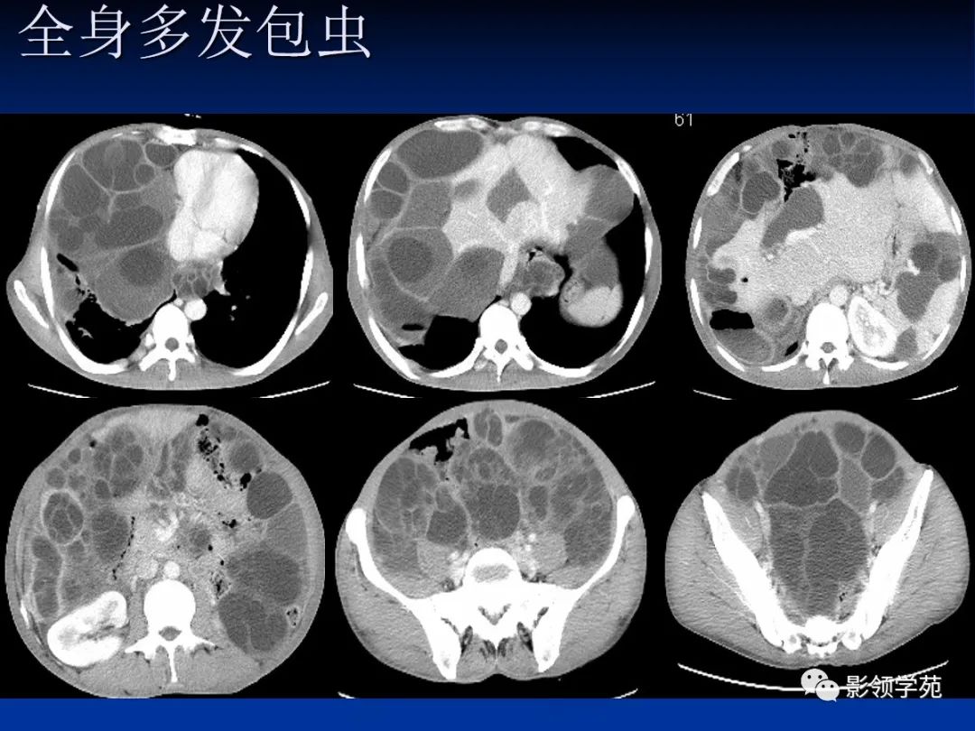 包虫病的影像学特点